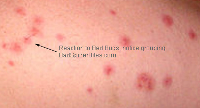 Bed bug bites skin reaction