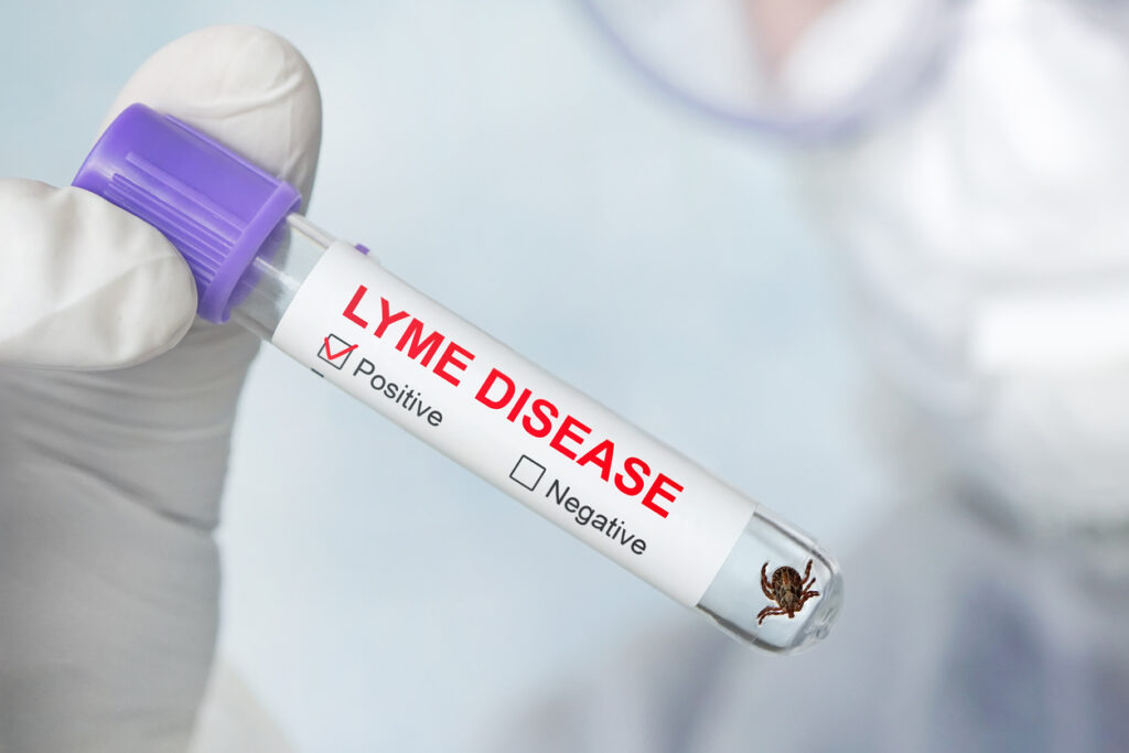Lyme disease label on a test tube in the hands of a laboratory assistant. dangerous carrier of Lyme disease in glass vial in a doctor's office. Diagnosing patients after a tick bite.
